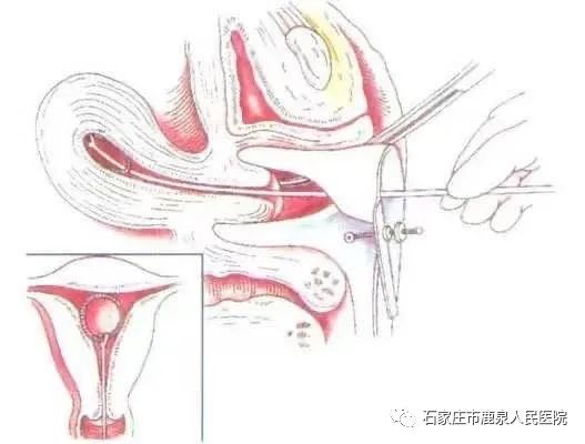 科技新宠，最新宫内环守护女性健康